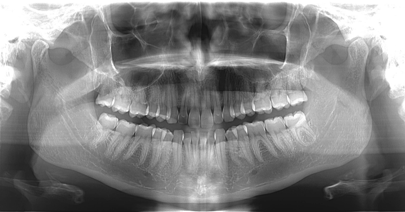 An OPG (Orthopantomagram) is a panoramic scanning dental X-ray of the upper and lower jaw. Perfectly healthy adult teeth.